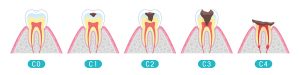 虫歯の進行と治療方法