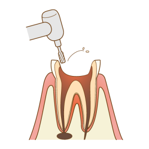根管治療の流れ