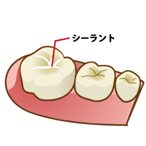「シーラント」で虫歯になりうる溝を埋める