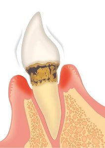 「中等度歯周炎」とは