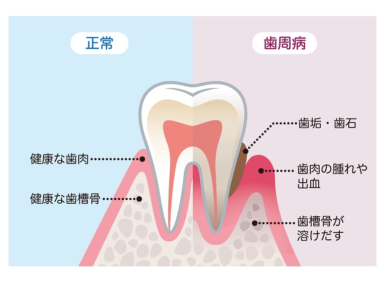 歯槽 膿 漏 は 治る のか