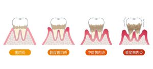 歯周病の進行