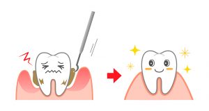 予防歯科のメリット・デメリット