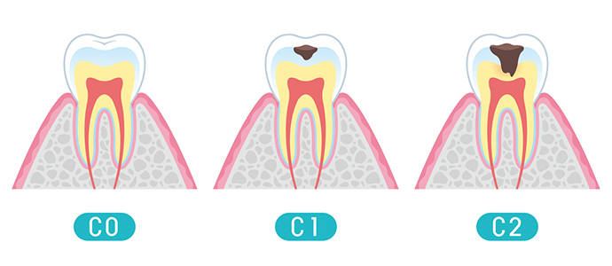 虫歯の進行と治療方法
