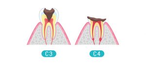 虫歯の進行と治療方法