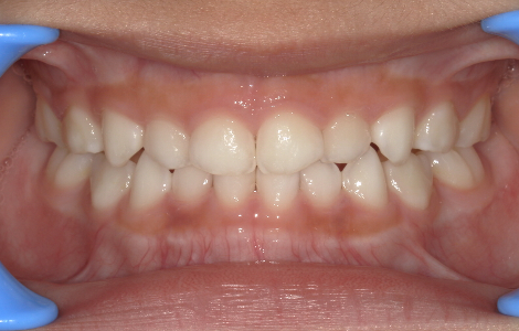 乳歯反対咬合術後3カ月