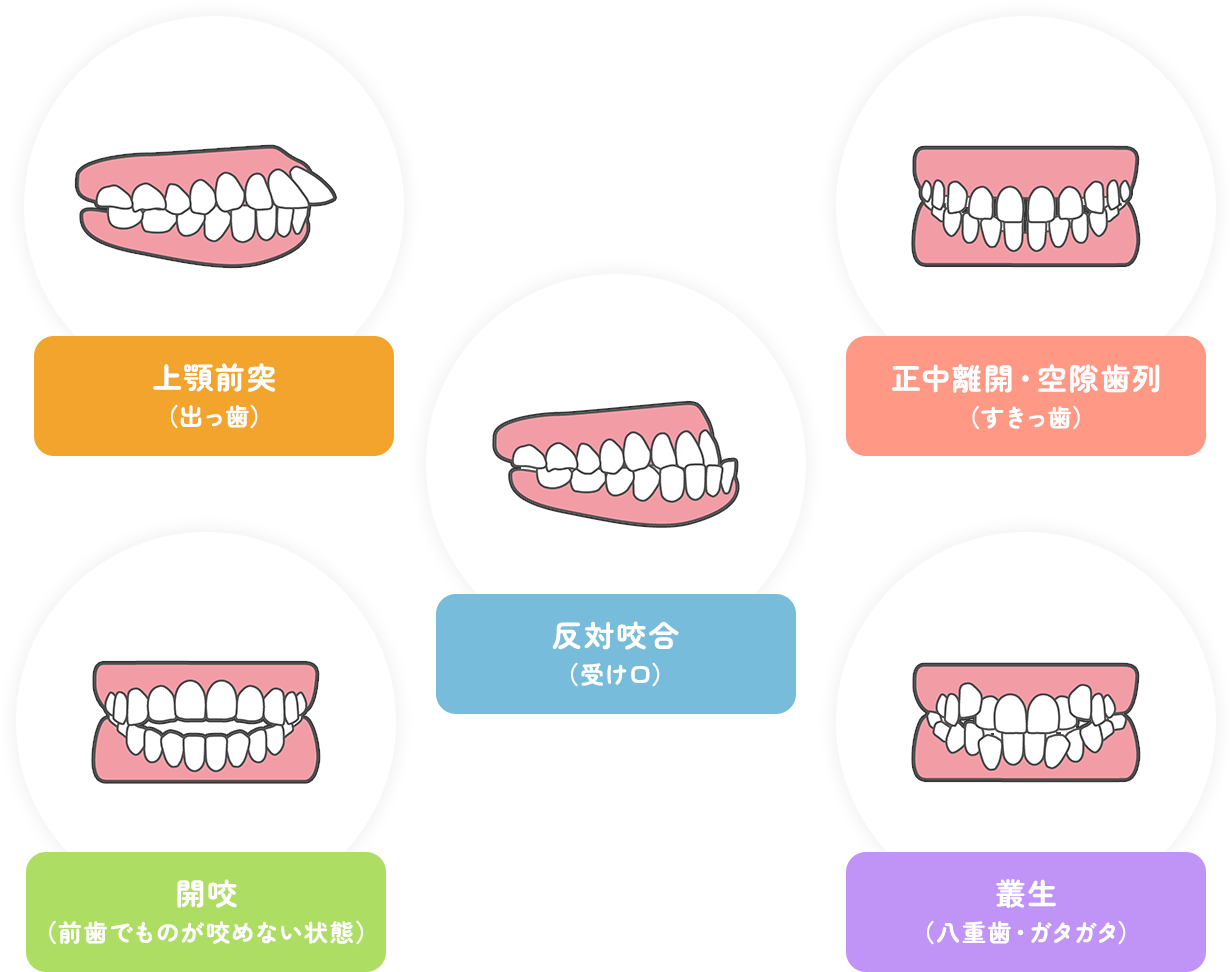 上顎前突 （出っ歯） 正中離開・空隙歯列 （すきっ歯） 反対咬合 （受け口） 開咬 （前歯でものが咬めない状態） 叢生 （八重歯・ガタガタ）