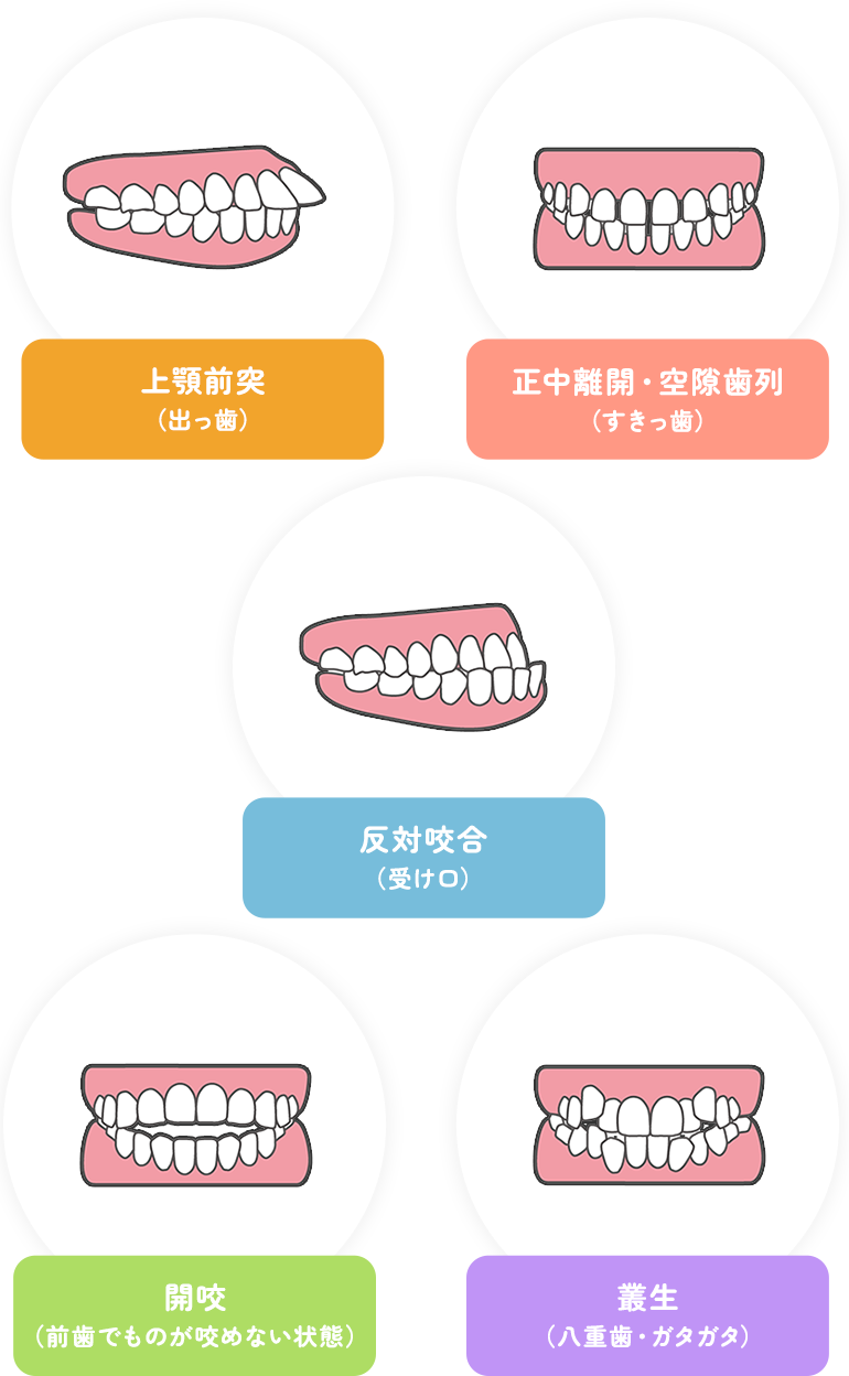 上顎前突 （出っ歯） 正中離開・空隙歯列 （すきっ歯） 反対咬合 （受け口） 開咬 （前歯でものが咬めない状態） 叢生 （八重歯・ガタガタ）